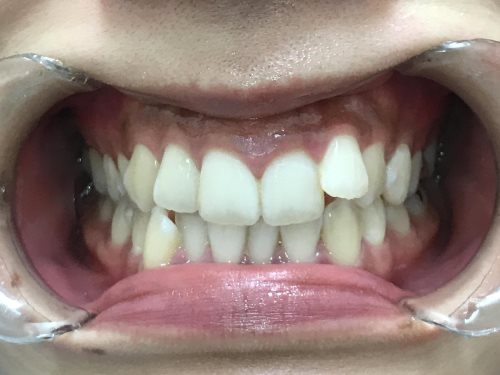 インビザライン治療　症例