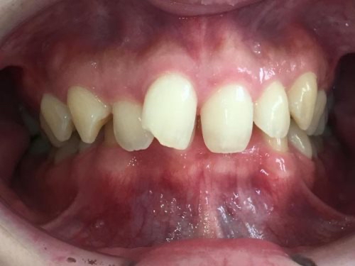 インビザライン治療 症例