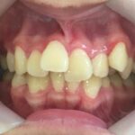 インビザライン治療　症例