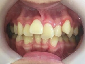 インビザライン治療　症例