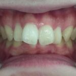 インビザライン治療　症例