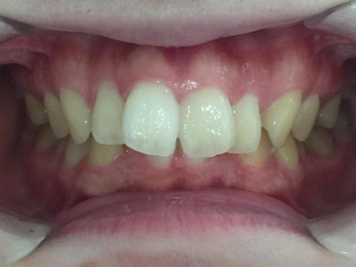 インビザライン治療 症例