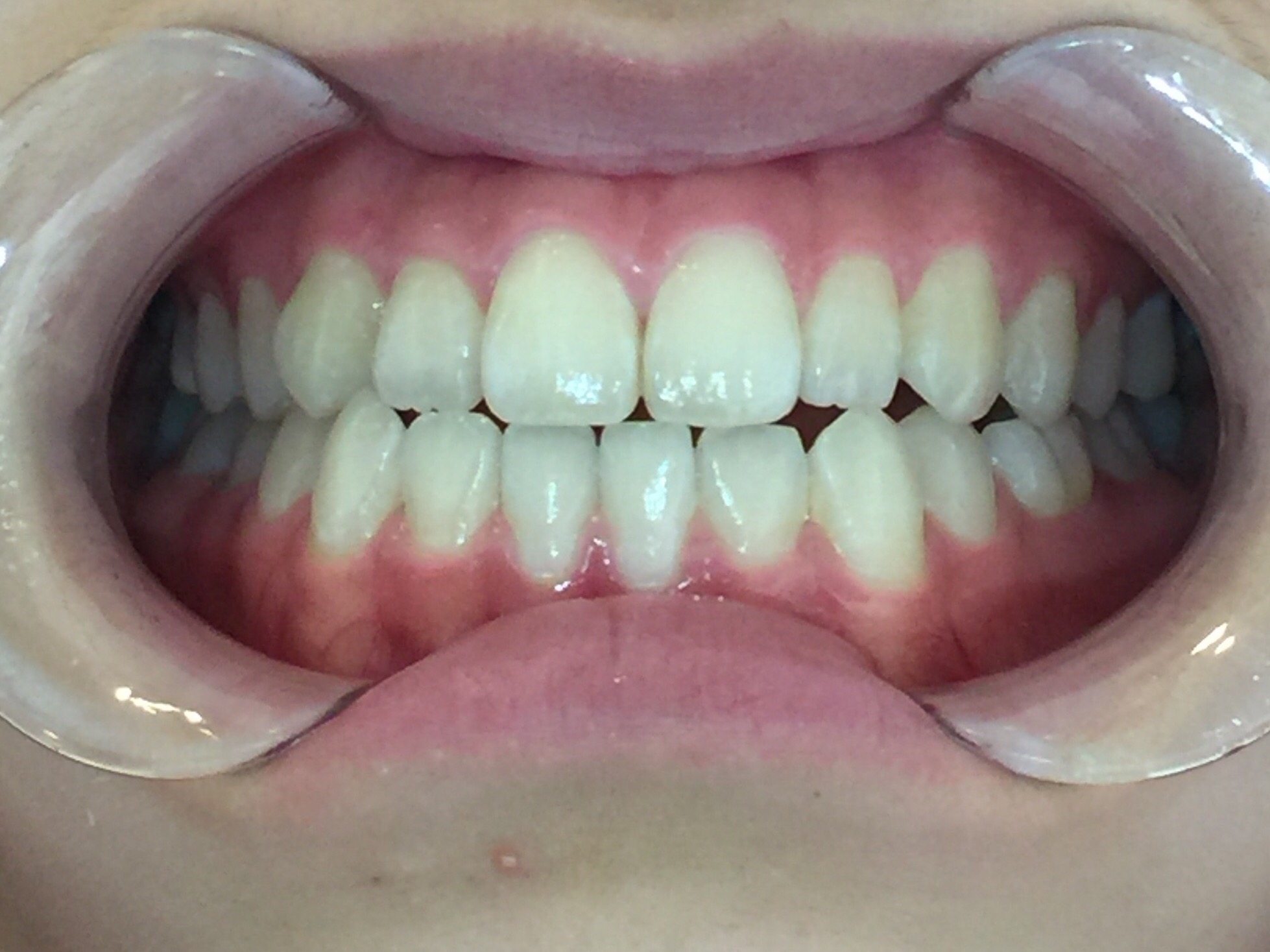 インビザラインGO治療 症例