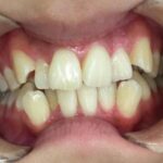 インビザライン治療　症例