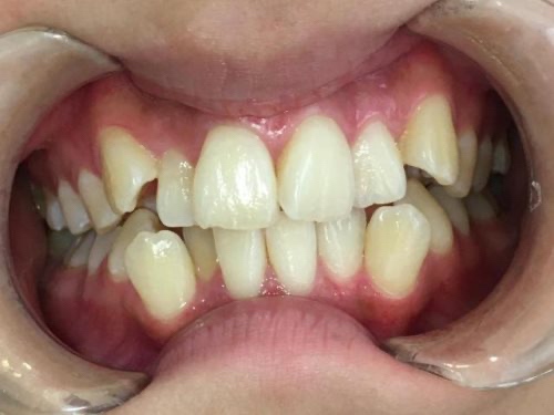 インビザライン治療　症例