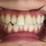 インビザライン治療　症例