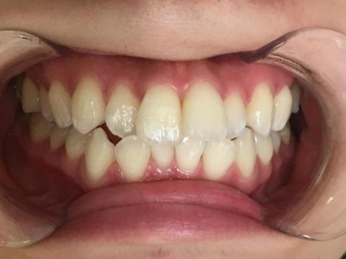 インビザライン治療　症例