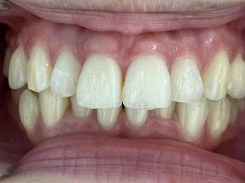 インビザライン治療 症例