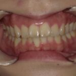 インビザライン治療　症例