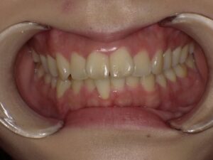 インビザライン治療　症例