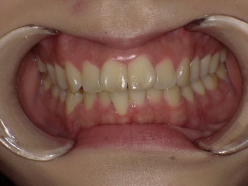 インビザライン治療 症例
