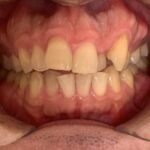 インビザライン治療　症例