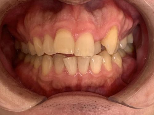 インビザライン治療　症例