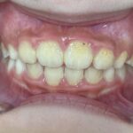 小児矯正　症例