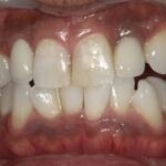 ホワイトニング　症例