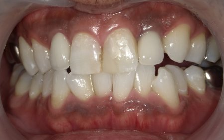 ホワイトニング 症例