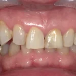 ホワイトニング　症例