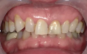 ホワイトニング　症例