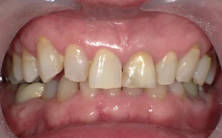 ホワイトニング 症例