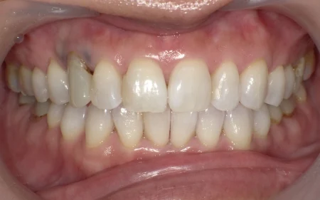 ホワイトニング 症例