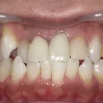 ホワイトニング　症例