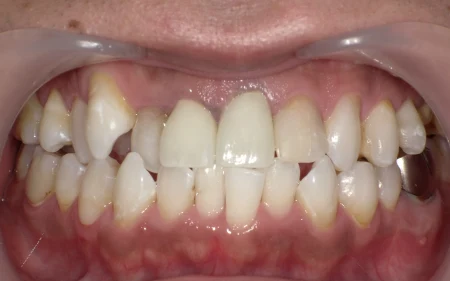 ホワイトニング 症例