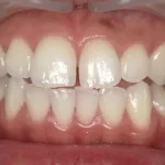 ホワイトニング　症例