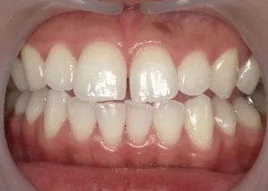 ホワイトニング　症例