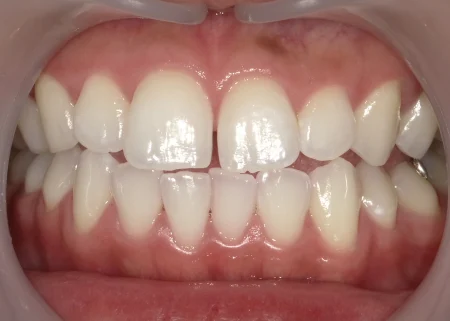 ホワイトニング　症例