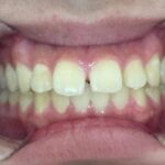 インビザラインGO治療　症例
