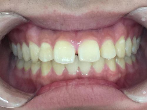 インビザラインGO治療　症例