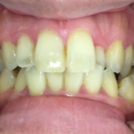 インビザライン治療　症例