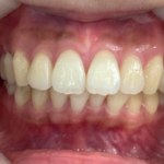 インビザライン治療　症例