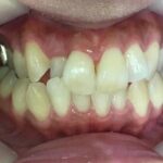 インビザライン治療　症例