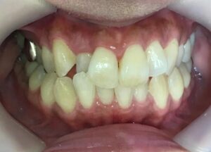 インビザライン治療　症例