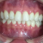 インビザラインGO治療　症例