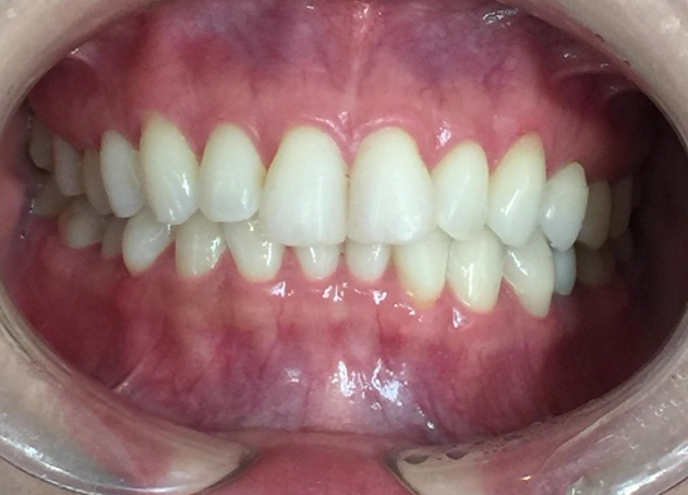 インビザラインGO治療 症例