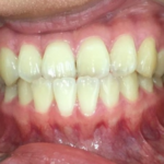 インビザラインGO治療　症例