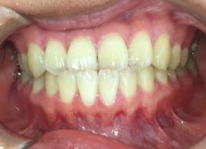 インビザラインGO治療　症例
