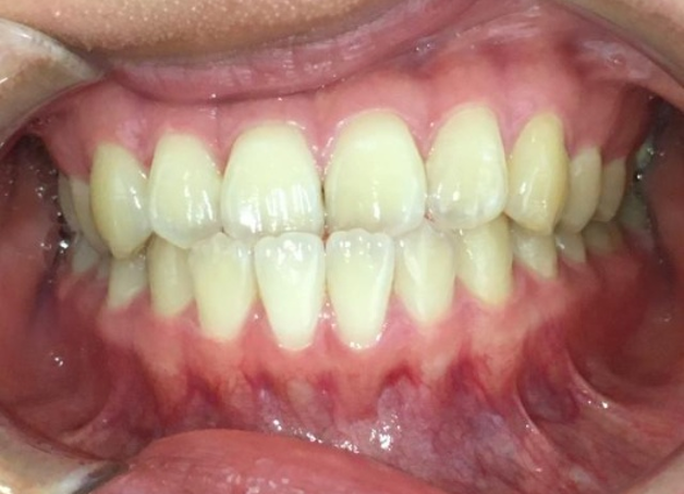 インビザラインGO治療 症例