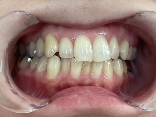 インビザライン治療 症例
