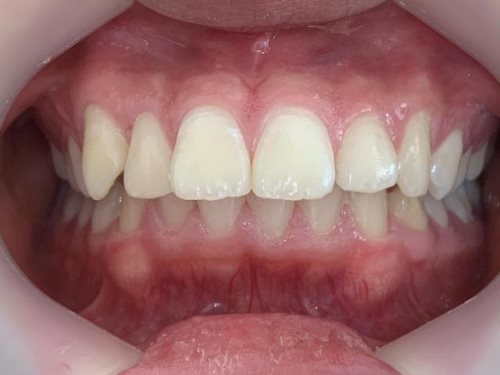インビザライン治療　症例
