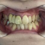 インビザライン治療　症例