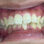 インビザライン治療　症例
