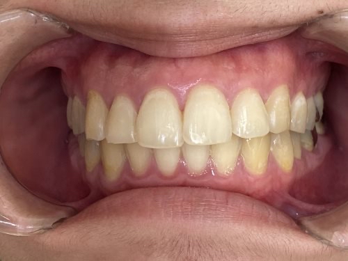 インビザライン治療 症例