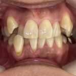 インビザライン治療　症例