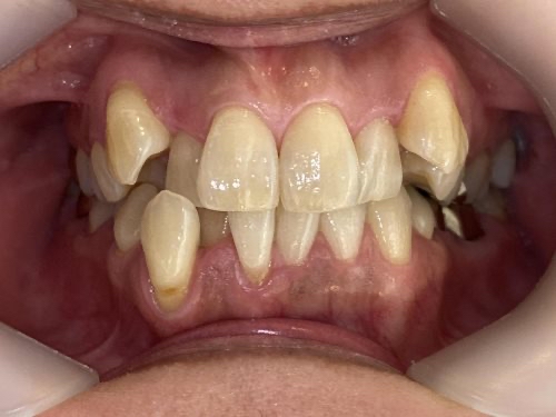 インビザライン治療　症例