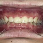 小児矯正　症例