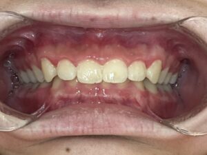 小児矯正　症例