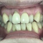 インビザライン治療　症例